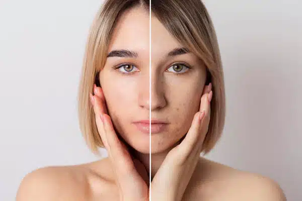 needling e microneedling 2